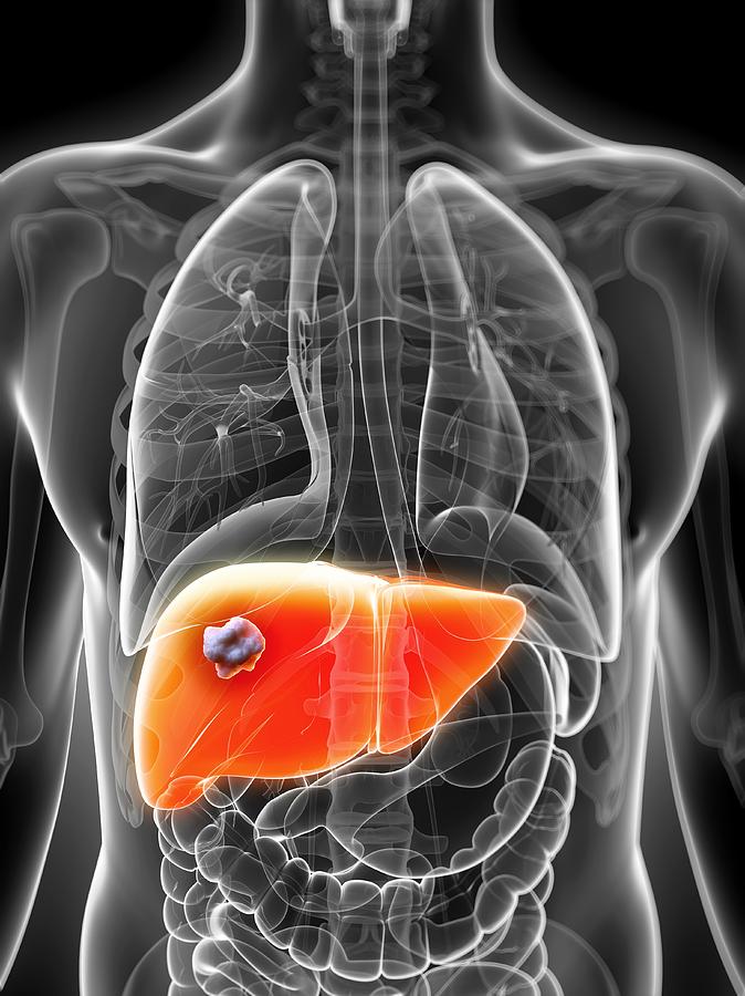 Human liver cancer, artwork Drawing by Sebastian Kaulitzki
