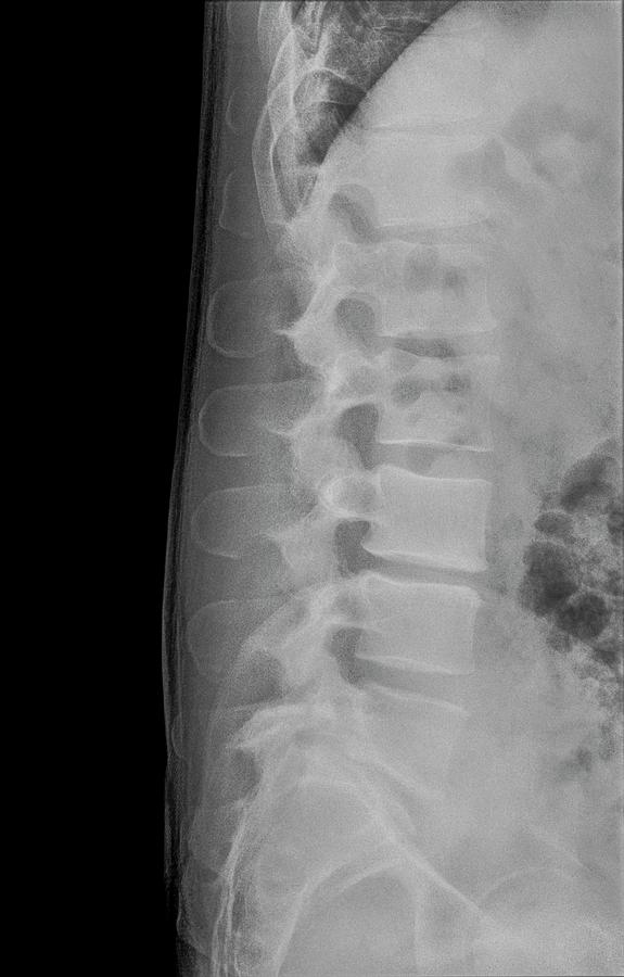 Human Lumbar Spine X-ray Photograph by Photostock-israel