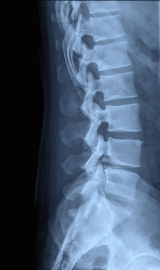 Human Lumbar Spine X-Ray side view Photograph by Cultura RM Exclusive/PhotoStock-Israel