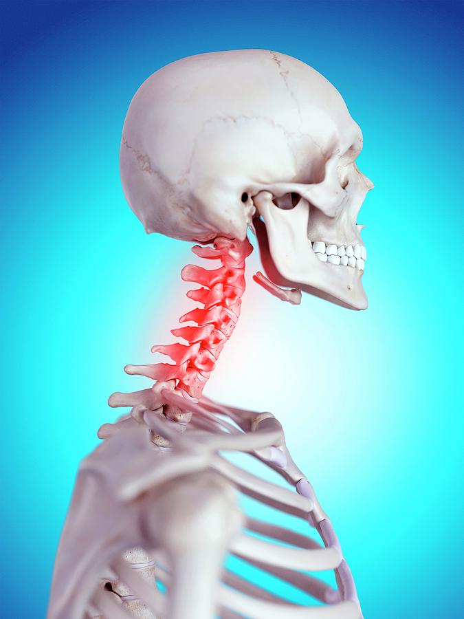 Human Neck Pain Photograph by Sebastian Kaulitzki/science Photo Library