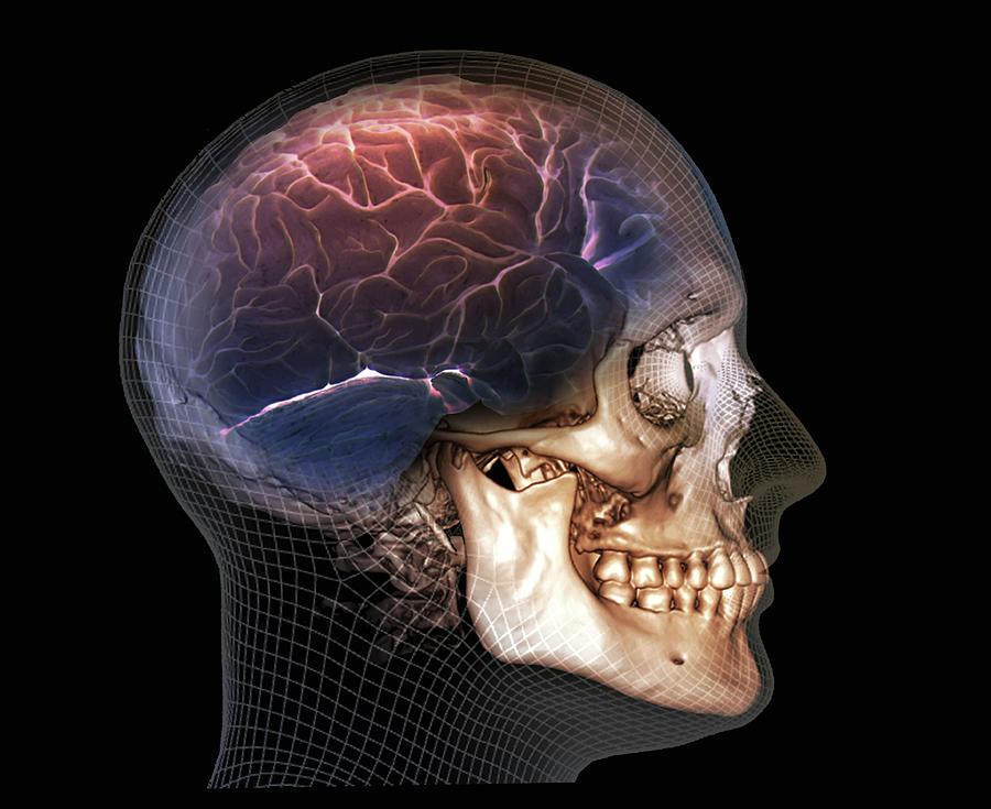 Human Skull And Brain Photograph by Zephyr/science Photo Library