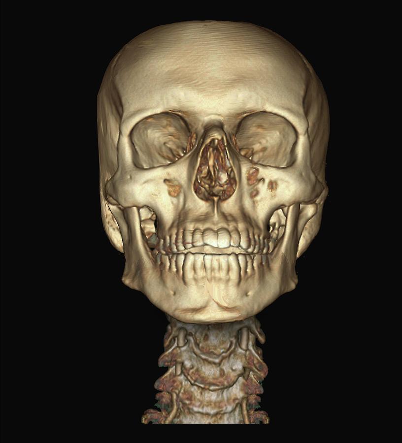 Human Skull And Spine Photograph By Zephyr Science Photo Library