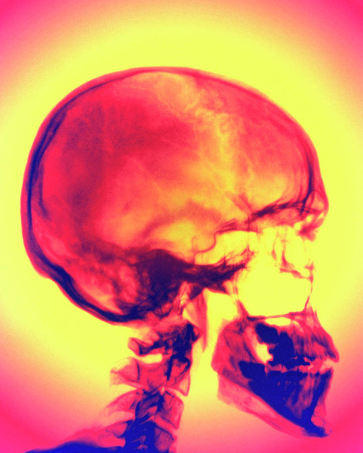 Human Skull X-ray Photograph by Alfred Pasieka/science Photo Library