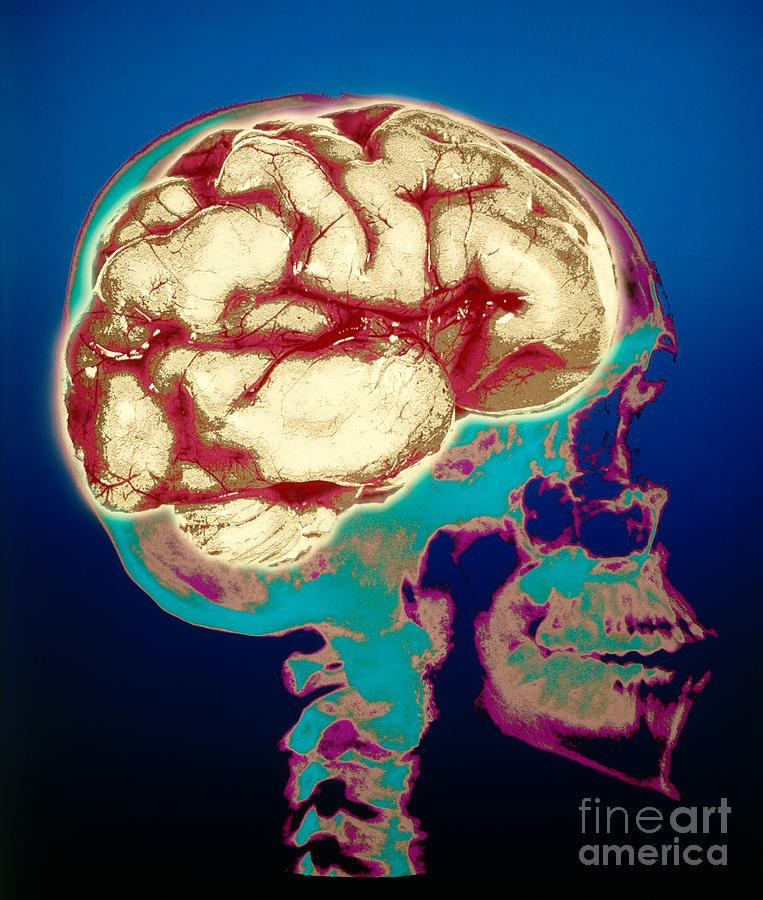 Human Skull X-ray With Digitized Brain Photograph by Bill Longcore