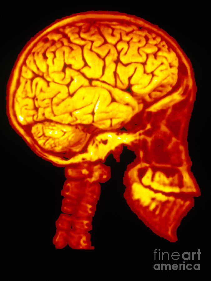 Human Skull X-ray With Digitized Brain Photograph by Scott Camazine