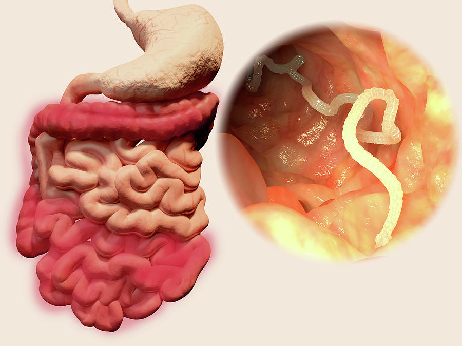 Human Tapeworm Infection Photograph By Juan Gaertner