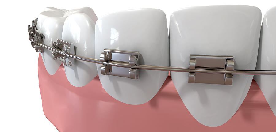Braces Digital Art - Human Teeth Extreme Closeup With Metal Braces by Allan Swart