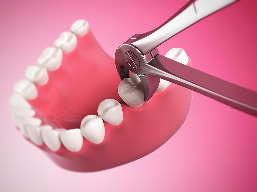 Human Tooth Being Removed Photograph by Sebastian Kaulitzki