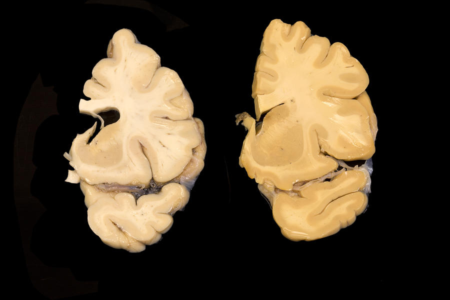 Huntingtons Disease And Normal Brain Photograph by Science Stock ...