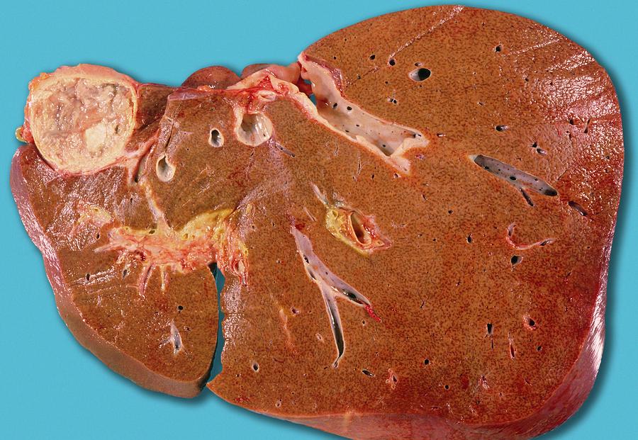 echinococcus-introduction-morphology-life-cycle-clinical-features