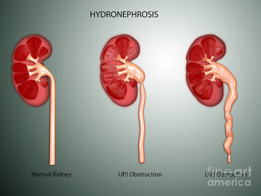Гидронефроз почек фото