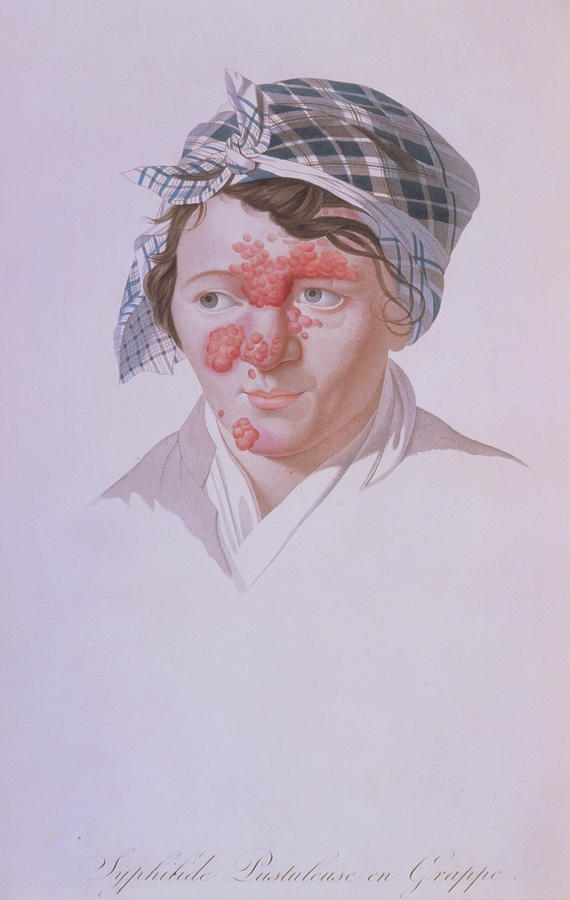 Illust. Of Woman With Facial Syphilis Pustules Photograph by Jean-loup Charmet/science Photo Library