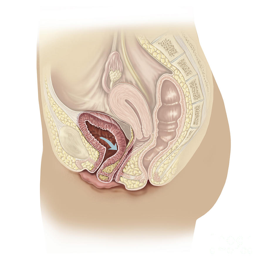 No People Digital Art - Illustration Of A Cystocele by TriFocal Communications