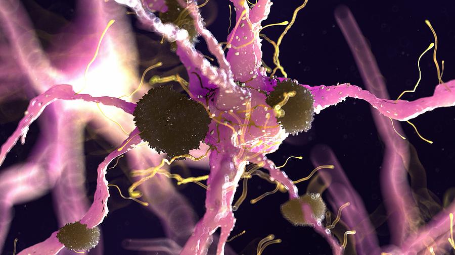 Illustration of Alzheimers disease Drawing by Sciepro/science Photo Library