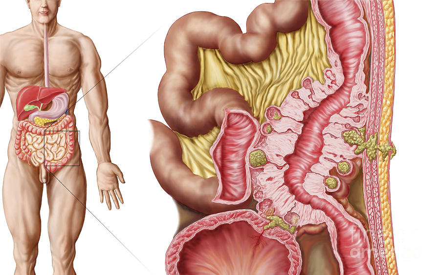 Diverticulosis del intestino delgado