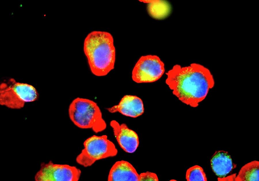 Immunofluorescent Lm Of Lgll Leukaemia Cells. Photograph by Nancy ...