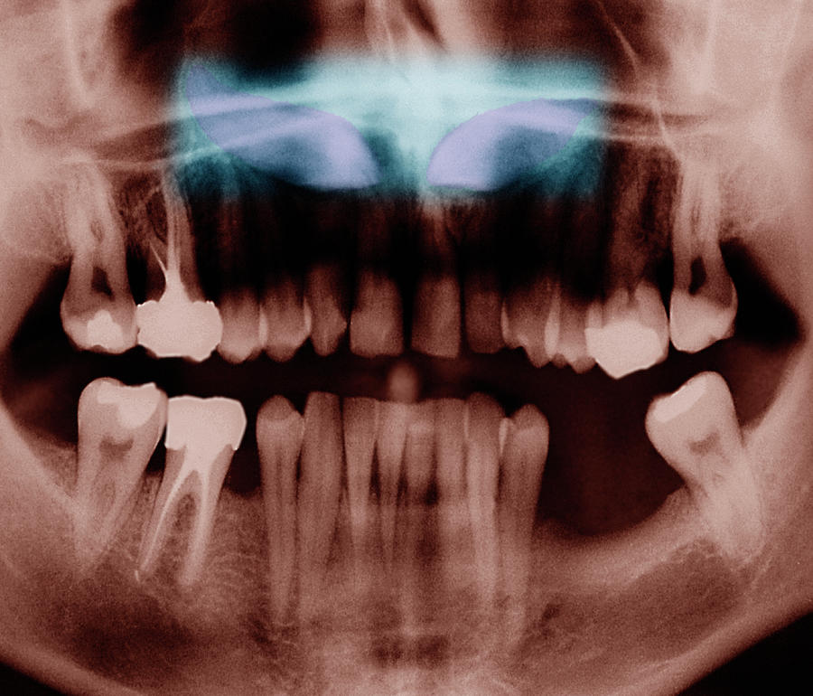 Incisors Photograph - Impacted Incisors by Zephyr/science Photo Library
