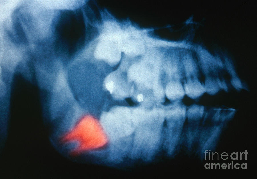 Impacted Wisdom Tooth, X-ray Photograph by Scott Camazine