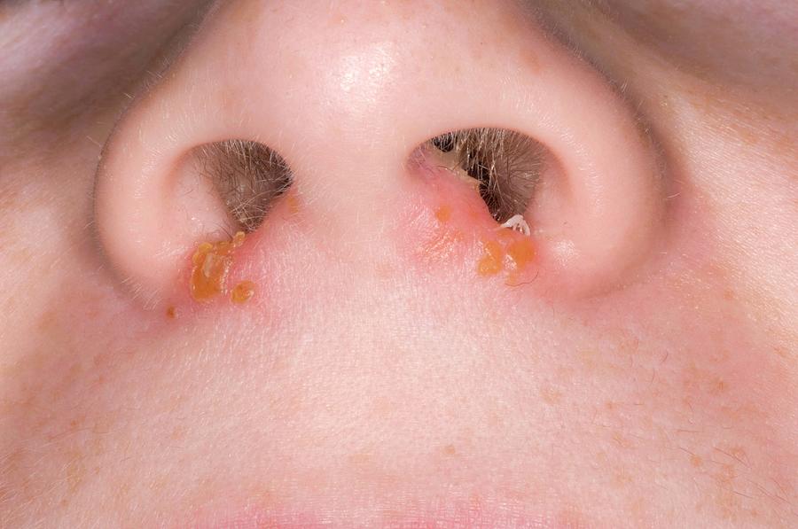 impetigo-infection-on-nose-photograph-by-dr-p-marazzi-science-photo