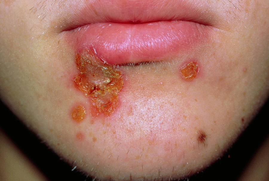 Impetigo Rash Beneath A Mans Lower Lip Photograph By Science Photo Library