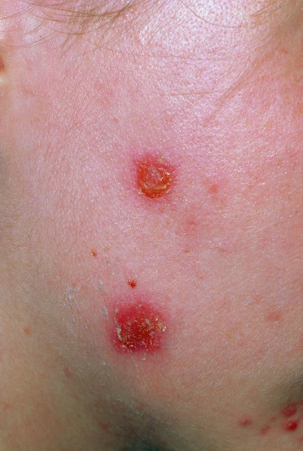 Impetigo Rash On Womans Face Following Facial Photograph By Dr P