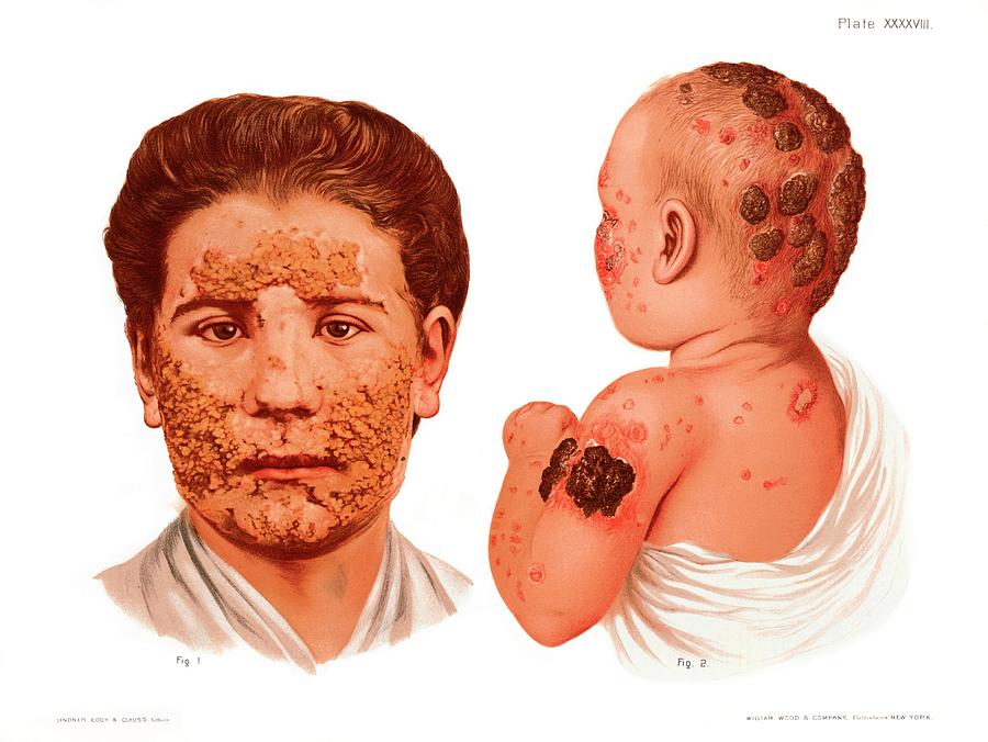 Impetigo Photograph by Us National Library Of Medicine/science Photo Library