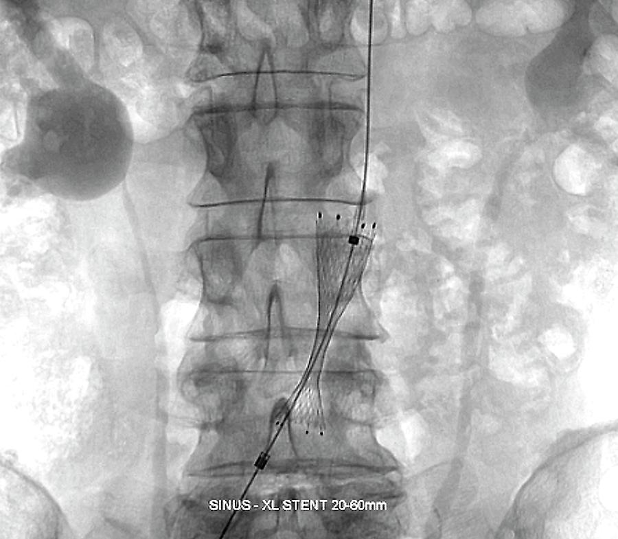 Implantation Of Stent In Aorta Photograph By Zephyr Science Photo Library Fine Art America