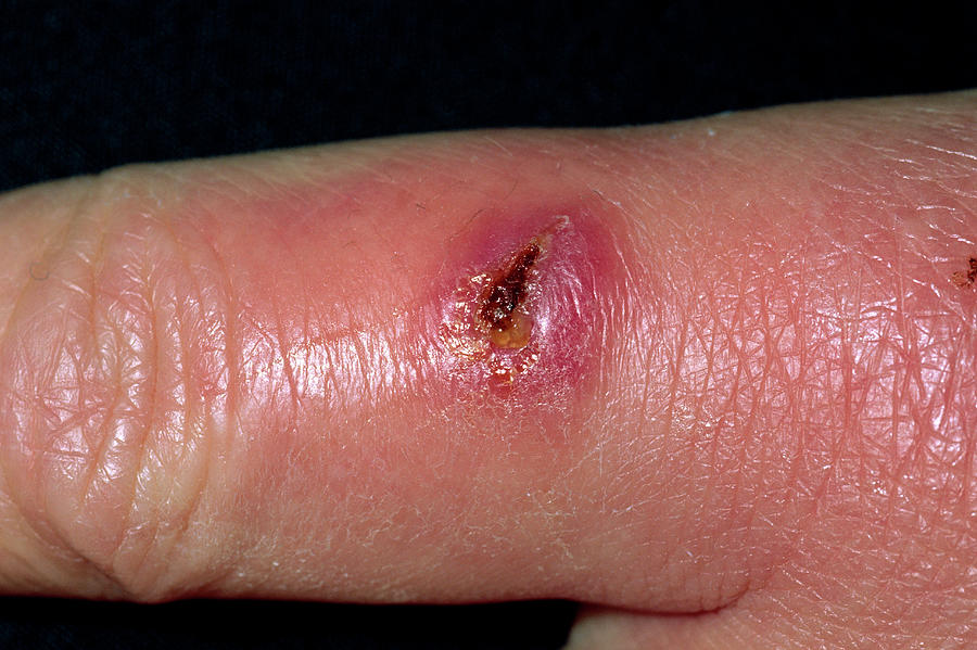 Can Small Infected Cuts Heal On Their Own