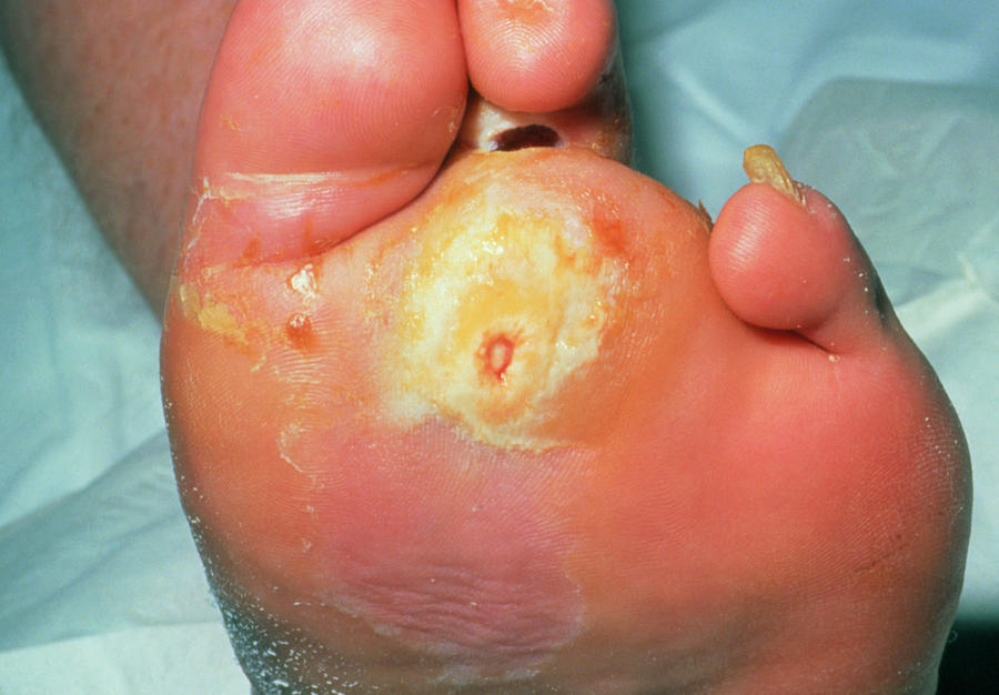 Infected Diabetic Ulcer On The Sole Of A Foot Photograph By Dr H C Free Hot Nude Porn Pic Gallery