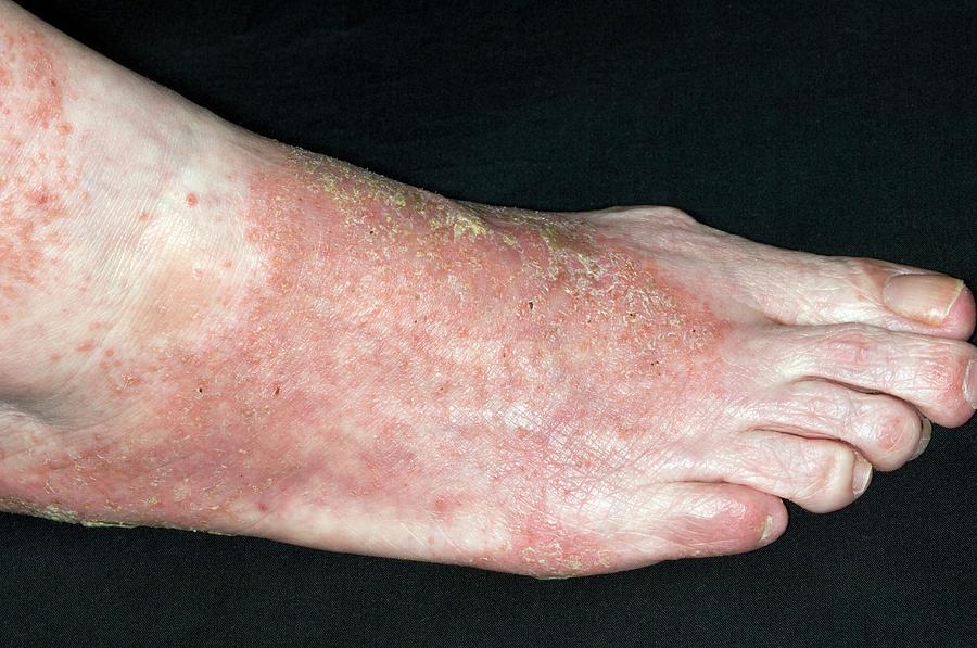 Infected Eczema On The Foot Photograph by Dr P. Marazzi/science Photo ...