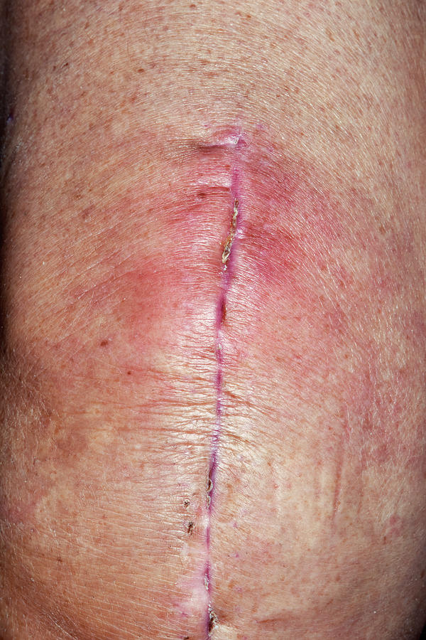 infected-knee-replacement-surgery-wound-photograph-by-dr-p-marazzi