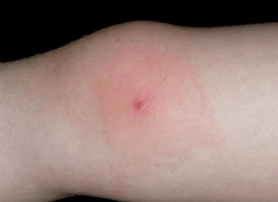 Infected Molluscum Contagiosum On Knee Photograph by Dr P. Marazzi ...