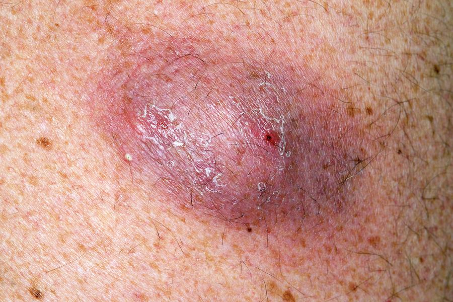 infected dermoid and sebaceous cysts