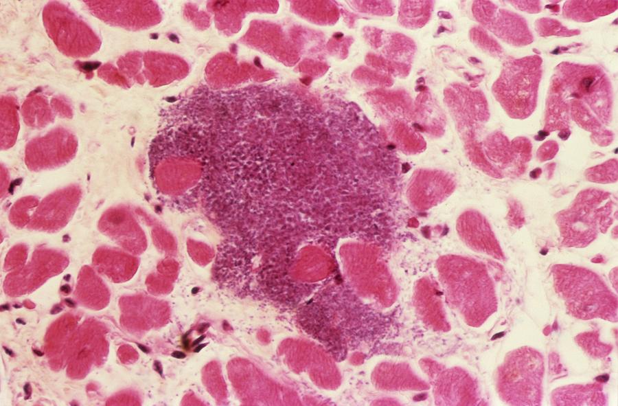 Infective Myocarditis Photograph by Pr. R. Abelanet - Cnri