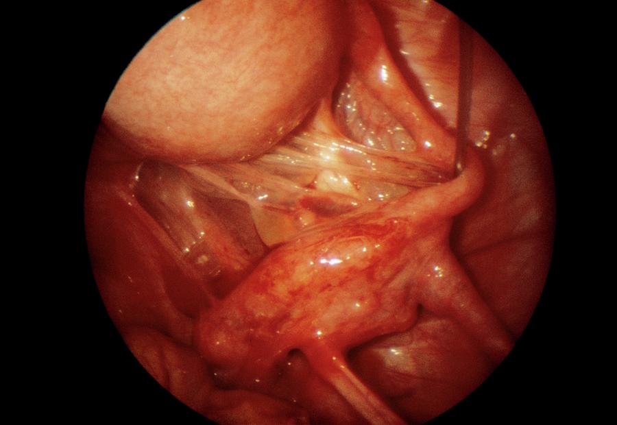 Endoscope Photograph - Inflamed Fallopian Tube And Ovary by Dr J. P. Abeille/science Photo Library