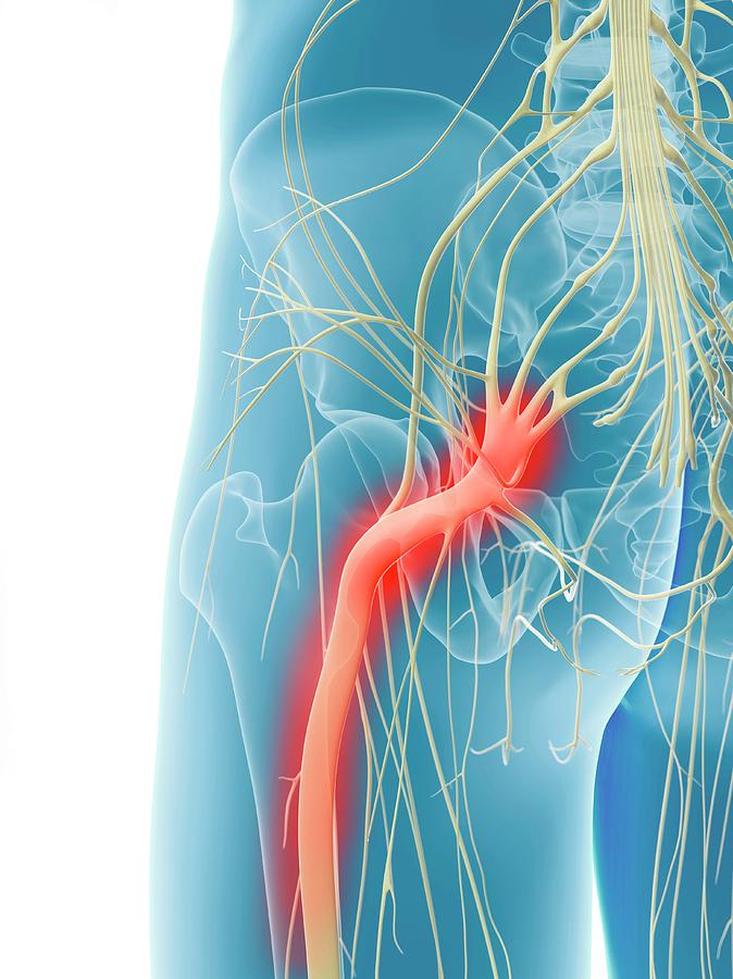 Inflamed Sciatic Nerve Photograph By Sciepro Pixels 7526