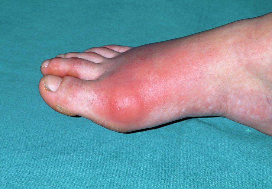 Inflamed Toe Joint In Patient With Gout Photograph by Dr P. Marazzi ...