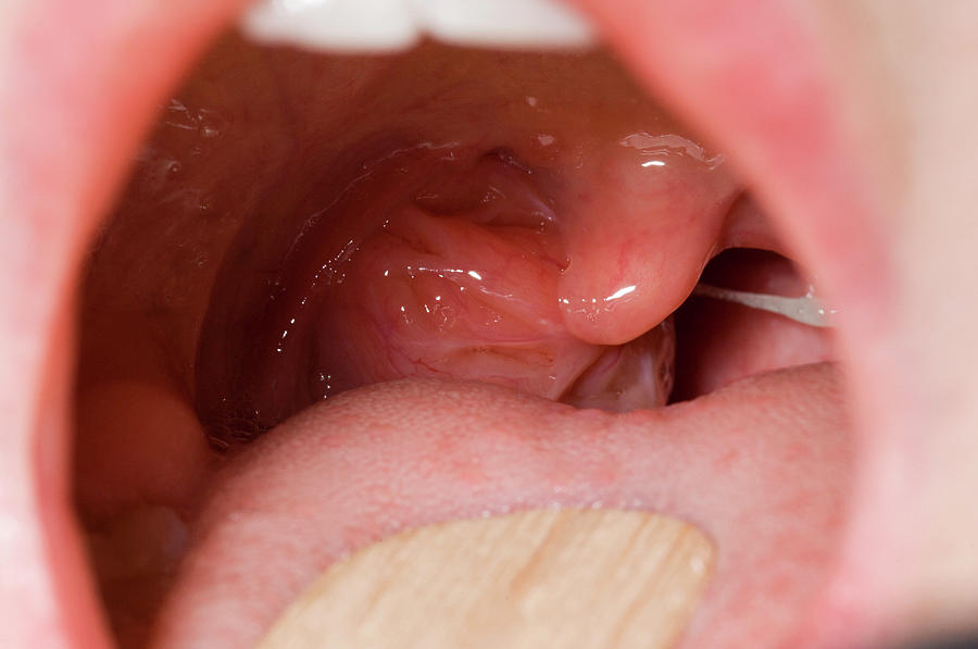 inflamed-tonsil-photograph-by-dr-p-marazzi-science-photo-library