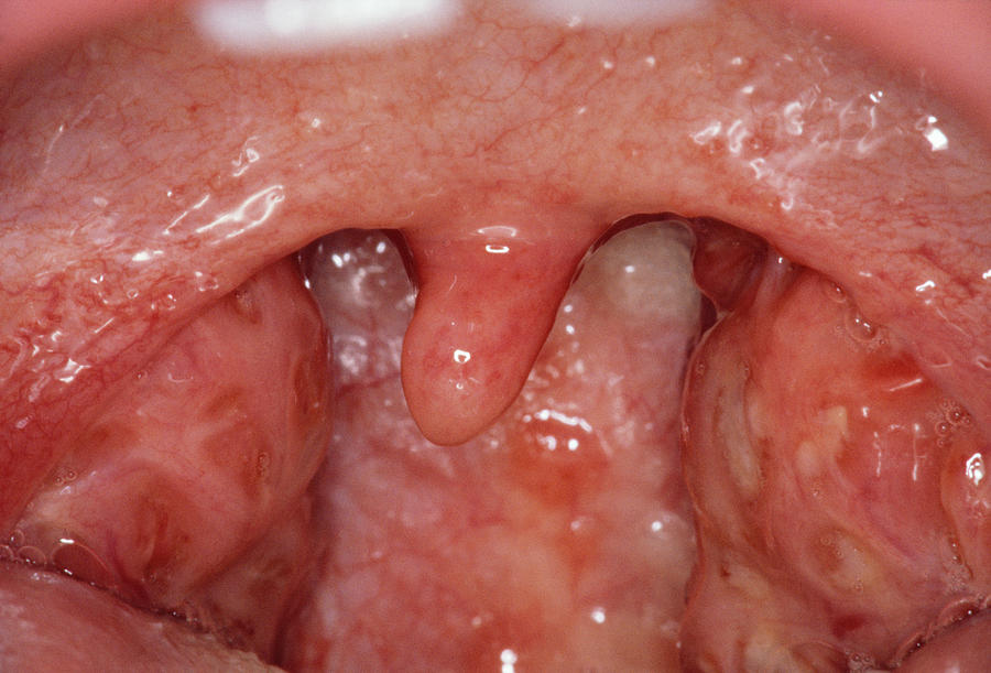 Inflamed Tonsils Photograph by Cnri/science Photo Library
