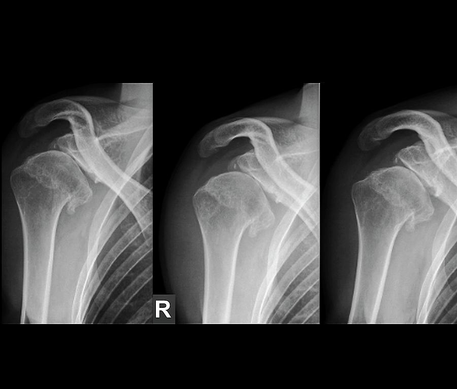 Injured Shoulder Photograph by Zephyr