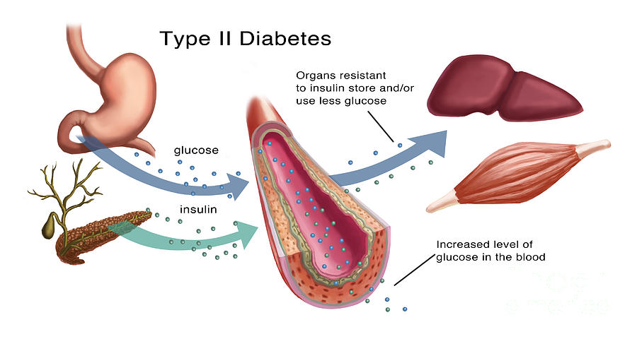 Insulinglucose Production In Type 2 Photograph by Spencer Sutton - Fine ...