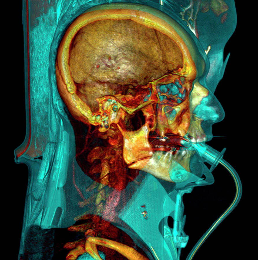 Skull Photograph - Intensive Care Patient by Antoine Rosset/science Photo Library