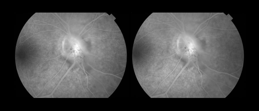 Intermediate Uveitis And Papillitis Photograph by Paul Whitten