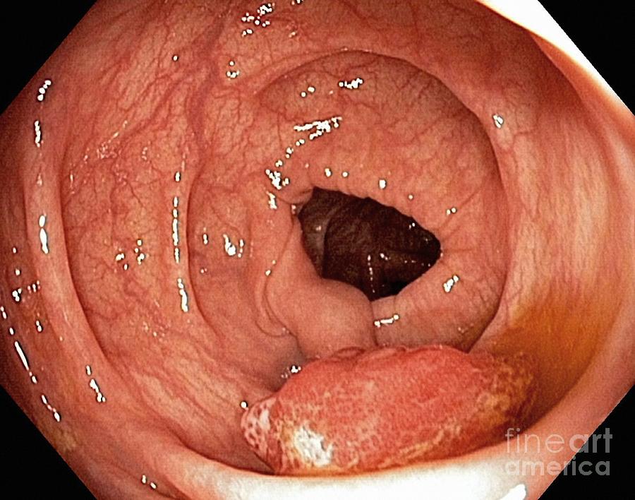 Abnormal Photograph - Intestinal Polyp, Endoscopic View by Gastrolab