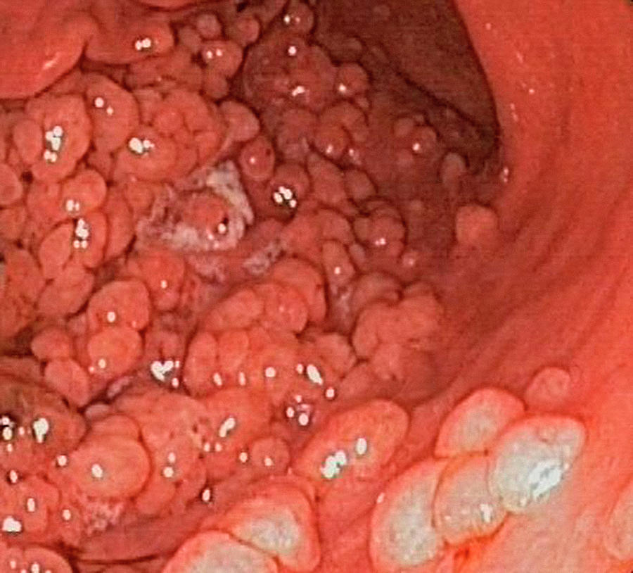 Abnormal Photograph - Intestinal Polyps by Gastrolab