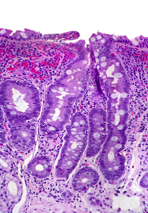 Intestinal Villi Of Celiac Disease Photograph by Science Stock Photography