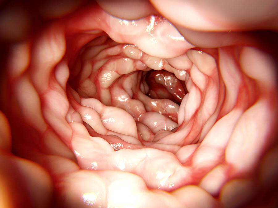 Intestine Affected By Crohns Disease Photograph by Juan Gaertner