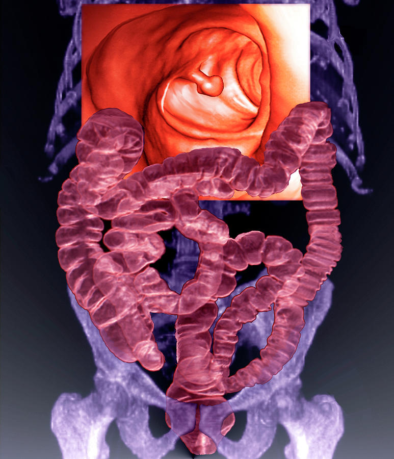 Intestines With Colon Polyp Photograph By Zephyrscience Photo Library 7849