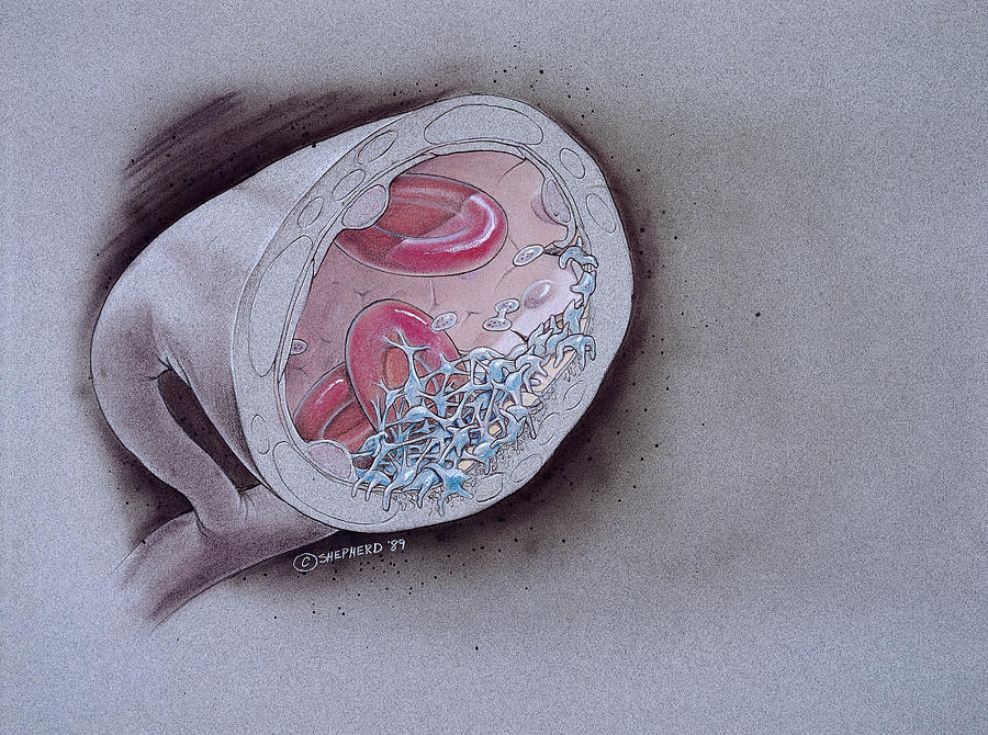 Illustration Photograph - Intra-arterial Clot Formation by Bob L. Shepherd