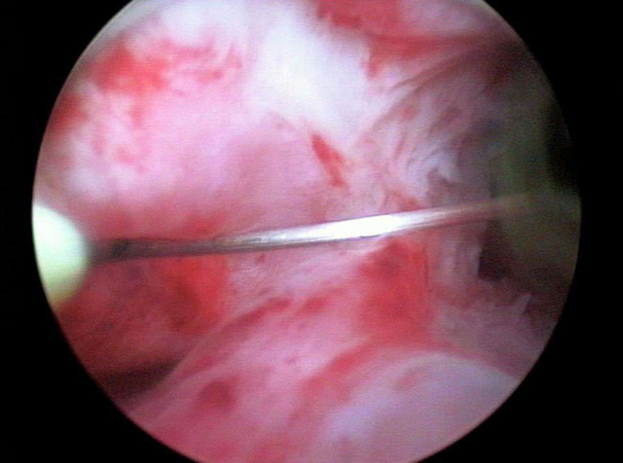 Intra-uterine Adhesion Surgery Photograph by Dr Najeeb Layyous/science Photo Library